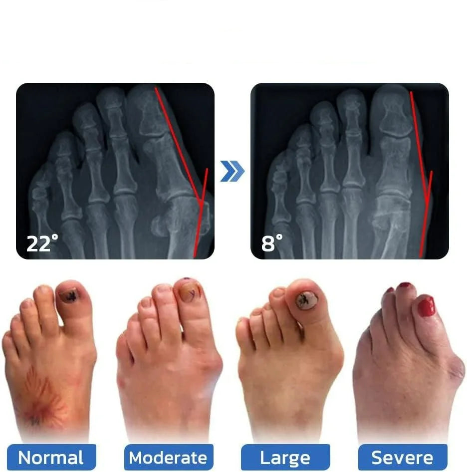 Calcetines antijuanetes y para la salud de las venas para mujeres y hombres